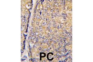 Formalin-fixed and paraffin-embedded human prostate carcinoma tissue reacted with STAP1 polyclonal antibody  , which was peroxidase-conjugated to the secondary antibody, followed by DAB staining. (STAP1 anticorps  (Phe56))