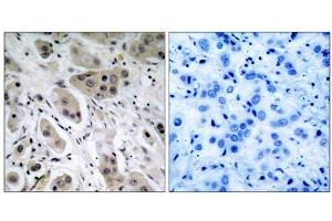 Immunohistochemical analysis of paraffin- embedded human breast carcinoma tissue, using Akt (phospho-Ser473) antibody (E011054). (AKT1 anticorps  (pSer473))
