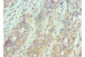 Immunohistochemistry of paraffin-embedded human endometrial cancer using ABIN7169126 at dilution of 1:100