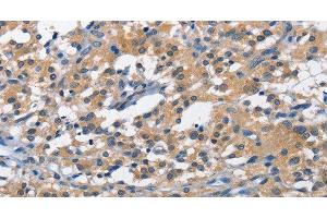 Immunohistochemistry of paraffin-embedded Human thyroid cancer tissue using PIM1 Polyclonal Antibody at dilution 1:40 (PIM1 anticorps)