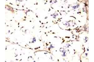 Immunohistochemical staining of IFITM1 on formalin fixed, paraffin embedded human intestines cancer tissue with IFITM1 polyclonal antibody . (IFITM1 anticorps  (N-Term))