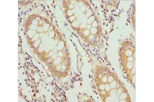 Immunohistochemistry of paraffin-embedded human colon cancer using ABIN7163635 at dilution of 1:100 (PLEKHA1 anticorps  (AA 285-404))