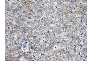 Immunohistochemical staining of paraffin-embedded Human liver tissue using anti-IGF2BP2 mouse monoclonal antibody. (IGF2BP2 anticorps)