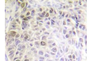 Immunohistochemistry analyzes of Ku70 antibody in paraffin-embedded human liver carcinoma tissue. (XRCC6 anticorps)