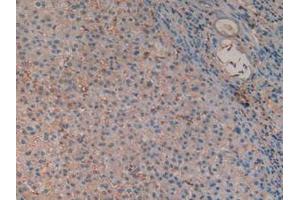 IHC-P analysis of Human Liver Cancer Tissue, with DAB staining. (Hemoglobin Subunit beta anticorps  (AA 1-147))