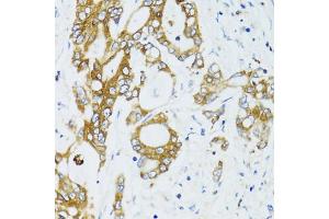 Immunohistochemistry of paraffin-embedded human colon carcinoma using SIRT2 antibody. (SIRT2 anticorps)