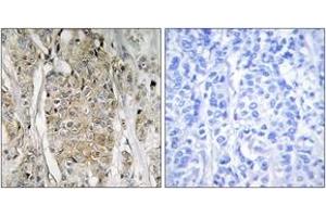 Immunohistochemistry analysis of paraffin-embedded human breast carcinoma tissue, using HER2 Antibody. (ErbB2/Her2 anticorps  (AA 641-690))