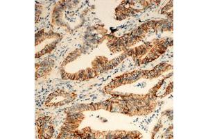 Immunohistochemical analysis of TUSC3 staining in human colon cancer formalin fixed paraffin embedded tissue section.