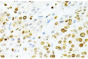 Immunohistochemistry of paraffin-embedded Human liver cancer using DKC1 Polyclonal Antibody at dilution of 1:200 (40x lens). (DKC1 anticorps)