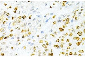 Immunohistochemistry of paraffin-embedded Human liver cancer using DKC1 Polyclonal Antibody at dilution of 1:200 (40x lens). (DKC1 anticorps)