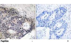 Immunohistochemistry analysis of paraffin-embedded human colon carcinoma tissue using ABHD12B polyclonal antibody . (ABHD12B anticorps)