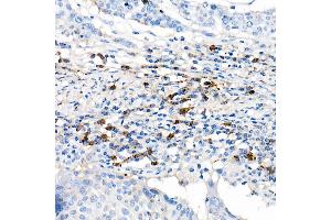 Immunohistochemistry of paraffin-embedded human cervix cancer using Lambda Light chain Rabbit mAb (ABIN7267847) at dilution of 1:100 (40x lens). (IGLV1-51 anticorps)