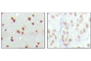 Immunohistochemical analysis of paraffin-embedded human cerebra (left) and lung carcinoma (right) tissues, showing nuclear localization with DAB staining using MDM4 mouse mAb. (MDM4-binding Protein anticorps)