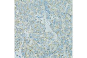 Immunohistochemistry of paraffin-embedded human colon carcinoma using TJP2 antibody.