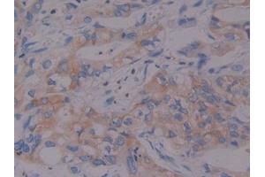 Detection of F1+2 in Human Bile duct cancer Tissue using Polyclonal Antibody to Prothrombin Fragment 1+2 (F1+2)