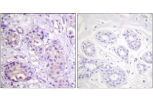 Immunohistochemistry analysis of paraffin-embedded human breast carcinoma, using IKK-beta (Phospho-Tyr199) Antibody. (IKBKB anticorps  (pTyr199))