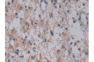 Detection of FAM3C in Human Glioma Tissue using Polyclonal Antibody to Family With Sequence Similarity 3, Member C (FAM3C) (FAM3C anticorps  (AA 25-227))