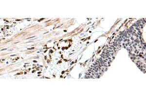 Immunohistochemistry of paraffin-embedded Human gastric cancer tissue using ARHGDIB Polyclonal Antibody at dilution of 1:35(x200) (ARHGDIB anticorps)