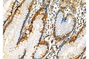 ABIN6262636 and ABIN6276998 at 1/100 staining Human gastric cancer and adjacent normal tissues by IHC-P. (Importin 5 anticorps  (Internal Region))