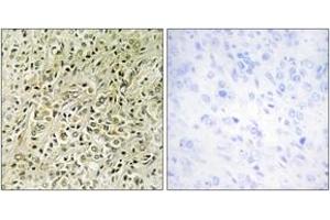 Immunohistochemistry analysis of paraffin-embedded human prostate carcinoma tissue, using RHG07 Antibody. (DLC1 anticorps  (AA 61-110))