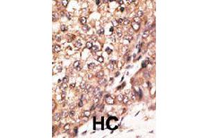 Formalin-fixed and paraffin-embedded human hepatocellular carcinoma tissue reacted with BMP7 polyclonal antibody  , which was peroxidase-conjugated to the secondary antibody, followed by DAB staining. (BMP7 anticorps  (N-Term))