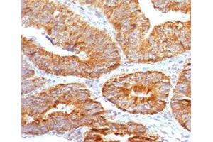 IHC testing of FFPE human colon carcinoma with TL1A antibody (clone TLRM1-1). (TNFSF15 anticorps)