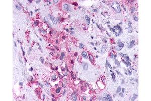 Anti-KISS1R / GPR54 antibody IHC of human Pancreas, Carcinoma. (KISS1R anticorps  (Cytoplasmic Domain))