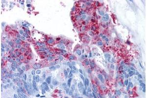 Human Colon Carcinoma (formalin-fixed, paraffin-embedded) stained with GPR124 antibody ABIN213374 at 11 ug/ml followed by biotinylated goat anti-rabbit IgG secondary antibody ABIN481713, alkaline phosphatase-streptavidin and chromogen. (GPR124 anticorps  (N-Term))
