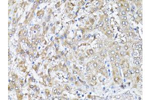 Immunohistochemistry of paraffin-embedded human liver using SNAI1 antibody (ABIN4905248) at dilution of 1:100 (40x lens). (SNAIL anticorps)