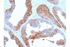 Formalin-fixed, paraffin-embedded human Prostate Carcinoma stained with HLA-DR Mouse Monoclonal Antibody (TAL 1B5). (HLA-DR anticorps)