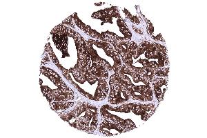 Prostate Prostatic adenocarcinoma Gleason 448 with strong diffuse PSAP positivity