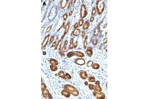 Immunohistochemical staining (Formalin-fixed paraffin-embedded sections) of human gastric carcinoma (A, B) with MUC6 monoclonal antibody, clone MUC6/916 . (MUC6 anticorps)