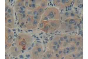 Detection of GBA in Human Liver cancer Tissue using Polyclonal Antibody to Glucocerebrosidase (GBA) (GBA anticorps  (AA 117-214))