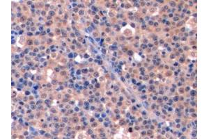 Detection of TYMS in Human Lymphoma Tissue using Polyclonal Antibody to Thymidylate Synthetase (TYMS)
