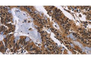 Immunohistochemistry of paraffin-embedded Human colon cancer tissue using EPHB6 Polyclonal Antibody at dilution 1:50 (EPH Receptor B6 anticorps)