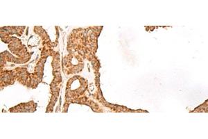 Immunohistochemistry of paraffin-embedded Human thyroid cancer tissue using GBGT1 Polyclonal Antibody at dilution of 1:40(x200) (GBGT1 anticorps)