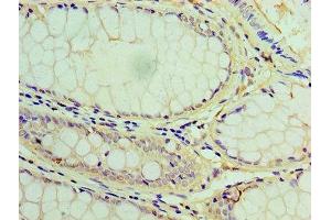 Immunohistochemistry of paraffin-embedded human colon cancer using ABIN7158764 at dilution of 1:100
