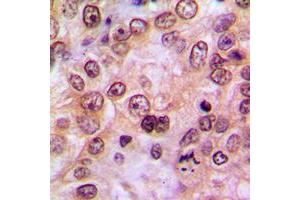 Immunohistochemical analysis of LIMK1/2 (pT508/505) staining in human breast cancer formalin fixed paraffin embedded tissue section. (LIMK-1/2 (C-Term), (pSer505), (pSer508) anticorps)