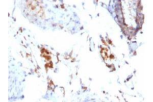 Formalin-fixed, paraffin-embedded Human Testicular Carcinoma stained with Ferritin, Light Chain Mouse Monoclonal Antibody (FTL/1386).
