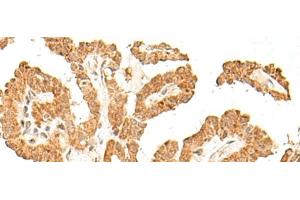 Immunohistochemistry of paraffin-embedded Human thyroid cancer tissue using FANCB Polyclonal Antibody at dilution of 1:60(x200)