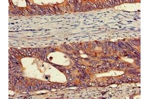 Immunohistochemistry of paraffin-embedded human colon cancer using ABIN7175913 at dilution of 1:100 (PEPD anticorps  (AA 258-395))