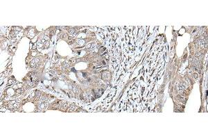 Immunohistochemistry of paraffin-embedded Human colorectal cancer tissue using RAD54B Polyclonal Antibody at dilution of 1:45(x200) (RAD54B anticorps)