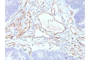 Formalin-fixed, paraffin-embedded colon carcinoma stained with CD31 antibody (C31.