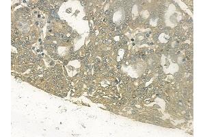 ABIN6255345 and ABIN6267144 at 1/100 staining human ovarian carcinoma by IHC-P. (NEDD4-2 anticorps  (pSer448))