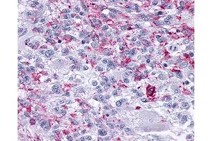 Anti-OPRM1 / Mu Opioid Receptor antibody IHC of human Brain, Glioblastoma.