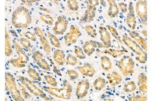 ABIN6264069 and ABIN6273289 at 1/100 staining Human kidney cancer and adjacent normal tissues by IHC-P. (PCMT1 anticorps  (Internal Region))
