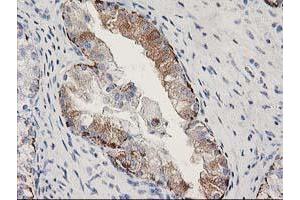 Immunohistochemical staining of paraffin-embedded Adenocarcinoma of Human ovary tissue using anti-MGLL mouse monoclonal antibody.