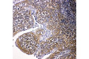 Anti-NOX2/gp91phox antibody, IHC(P) IHC(P): Human Intestinal Cancer Tissue (CYBB anticorps  (Middle Region))