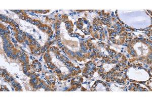 Immunohistochemistry of paraffin-embedded Human thyroid cancer using INTS10 Polyclonal Antibody at dilution of 1:50 (INTS10 anticorps)
