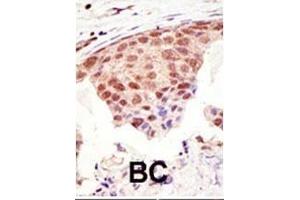 Formalin-fixed and paraffin-embedded human cancer tissue reacted with the primary antibody, which was peroxidase-conjugated to the secondary antibody, followed by DAB staining. (SUMO1 anticorps  (C-Term))